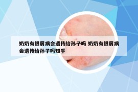 奶奶有銀屑病會遺傳給孫子嗎 奶奶有銀屑病會遺傳給孫子嗎知乎