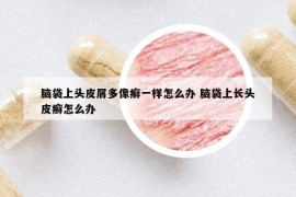 腦袋上頭皮屑多像癬一樣怎么辦 腦袋上長(zhǎng)頭皮癬怎么辦