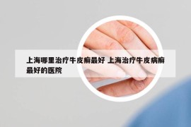 上海哪里治療牛皮癬最好 上海治療牛皮病癬最好的醫(yī)院