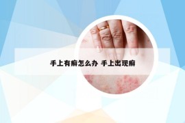 手上有癬怎么辦 手上出現(xiàn)癬