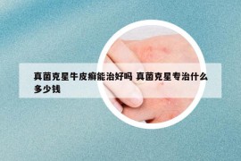 真菌克星牛皮癬能治好嗎 真菌克星專治什么多少錢