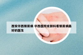 西安華西銀屑病 華西醫(yī)院皮膚科看銀屑病最好的醫(yī)生