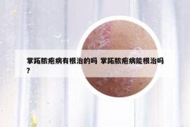 掌跖膿皰病有根治的嗎 掌跖膿皰病能根治嗎?