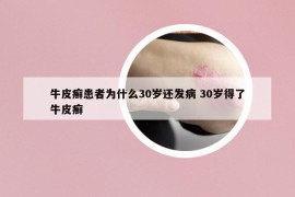 牛皮癬患者為什么30歲還發(fā)病 30歲得了牛皮癬