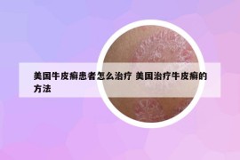 美國(guó)牛皮癬患者怎么治療 美國(guó)治療牛皮癬的方法