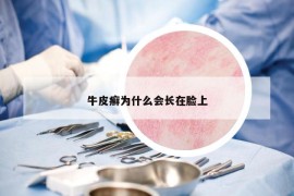牛皮癬為什么會(huì)長(zhǎng)在臉上