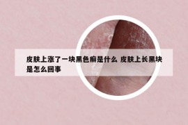 皮膚上漲了一塊黑色癬是什么 皮膚上長黑塊是怎么回事