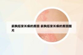 前胸后背長(zhǎng)癬的原因 前胸后背長(zhǎng)癬的原因圖片