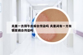 夫妻一方得牛皮癬會(huì)傳染嗎 夫妻間有一方有銀屑病會(huì)傳染嗎