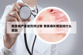 銀屑病嚴(yán)重低熱伴過敏 銀屑病長期低燒什么原因