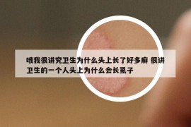 哦我很講究衛(wèi)生為什么頭上長(zhǎng)了好多癬 很講衛(wèi)生的一個(gè)人頭上為什么會(huì)長(zhǎng)虱子