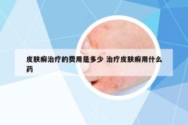 皮膚癬治療的費(fèi)用是多少 治療皮膚癬用什么藥