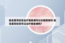 他克莫司軟膏治療銀屑病可以長(zhǎng)期使用嗎 他克莫司軟膏可以治療銀屑病嗎?