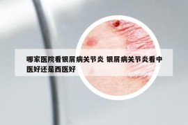 哪家醫(yī)院看銀屑病關節(jié)炎 銀屑病關節(jié)炎看中醫(yī)好還是西醫(yī)好