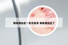 銀屑病治愈一定會復(fù)發(fā) 銀屑病治愈了