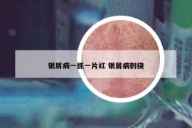銀屑病一抓一片紅 銀屑病刺撓