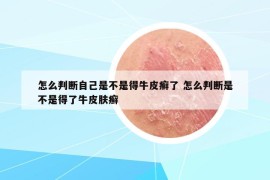 怎么判斷自己是不是得牛皮癬了 怎么判斷是不是得了牛皮膚癬