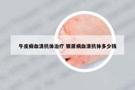 牛皮癬血清抗體治療 銀屑病血清抗體多少錢