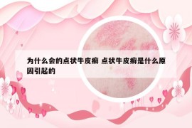 為什么會(huì)的點(diǎn)狀牛皮癬 點(diǎn)狀牛皮癬是什么原因引起的
