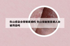 傷口感染會得銀屑病嗎 傷口接觸銀屑病人會被傳染嗎