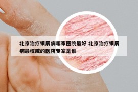 北京治療銀屑病哪家醫(yī)院最好 北京治療銀屑病最權(quán)威的醫(yī)院專家是誰(shuí)