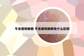 牛皮癬和腳癬 牛皮癬和腳癬有什么區(qū)別