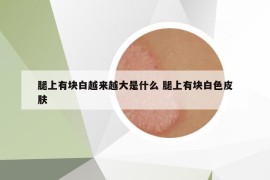 腿上有塊白越來越大是什么 腿上有塊白色皮膚