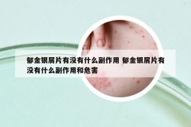 郁金銀屑片有沒(méi)有什么副作用 郁金銀屑片有沒(méi)有什么副作用和危害