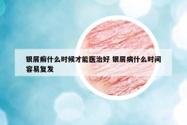 銀屑癬什么時(shí)候才能醫(yī)治好 銀屑病什么時(shí)間容易復(fù)發(fā)