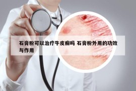 石膏粉可以治療牛皮癬嗎 石膏粉外用的功效與作用