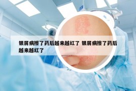 銀屑病擦了藥后越來(lái)越紅了 銀屑病擦了藥后越來(lái)越紅了