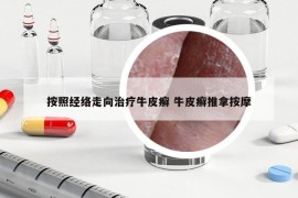 按照經(jīng)絡走向治療牛皮癬 牛皮癬推拿按摩
