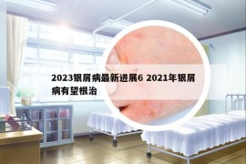 2023銀屑病最新進(jìn)展6 2021年銀屑病有望根治