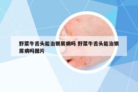 野菜牛舌頭能治銀屑病嗎 野菜牛舌頭能治銀屑病嗎圖片