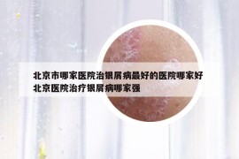北京市哪家醫(yī)院治銀屑病最好的醫(yī)院哪家好 北京醫(yī)院治療銀屑病哪家強