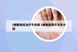 t細(xì)胞免疫治療牛皮癬 t細(xì)胞免疫療法多少錢