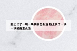 臉上長(zhǎng)了一塊一塊的癬怎么治 臉上長(zhǎng)了一塊一塊的癬怎么治