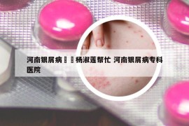 河南銀屑病來(lái)問(wèn)楊淑蓮幫忙 河南銀屑病?？漆t(yī)院