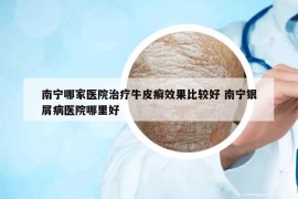 南寧哪家醫(yī)院治療牛皮癬效果比較好 南寧銀屑病醫(yī)院哪里好