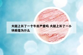 大腿上長了一個牛皮嚴重嗎 大腿上長了一小塊癬是為什么