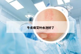 牛皮癬艾葉水泡好了