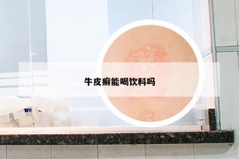 牛皮癬能喝飲料嗎