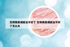 否則銀屑病就治不好了 否則銀屑病就治不好了怎么辦