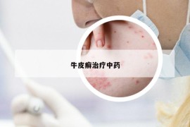 牛皮癬治療中藥
