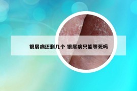銀屑病還剩幾個 銀屑病只能等死嗎