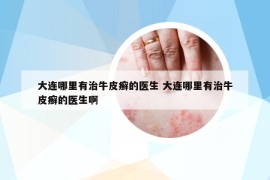 大連哪里有治牛皮癬的醫(yī)生 大連哪里有治牛皮癬的醫(yī)生啊