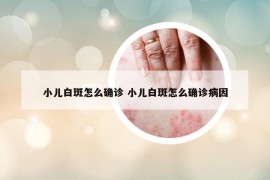 小兒白斑怎么確診 小兒白斑怎么確診病因