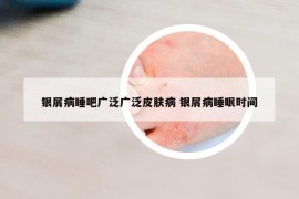 銀屑病睡吧廣泛廣泛皮膚病 銀屑病睡眠時間
