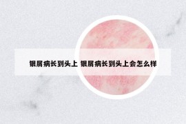 銀屑病長到頭上 銀屑病長到頭上會怎么樣