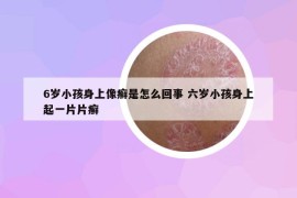 6歲小孩身上像癬是怎么回事 六歲小孩身上起一片片癬